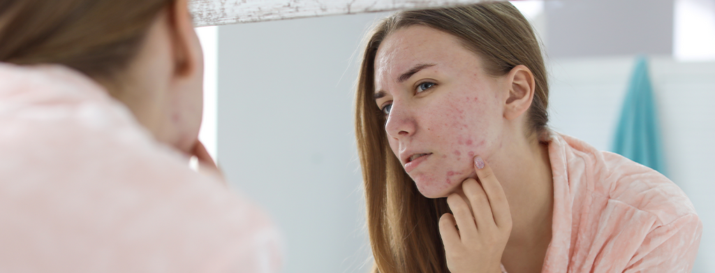 Why Do We Get Period acne?
